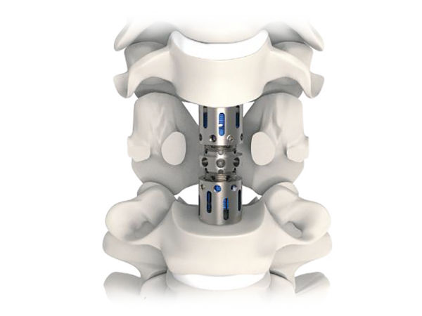Vertelift-C Anterior Cervical Corpectomy Cage