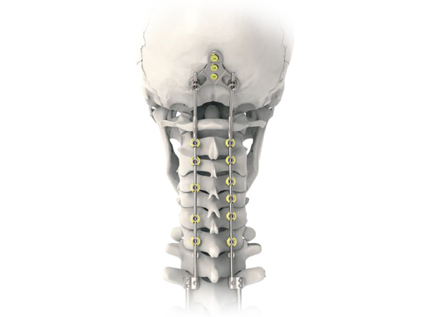 Oxis Plus Occipitocervical Fixation System