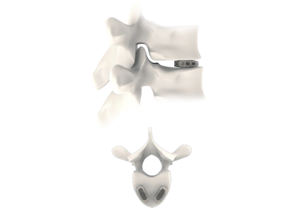 Tra-Ti Trabecular Plif Cage