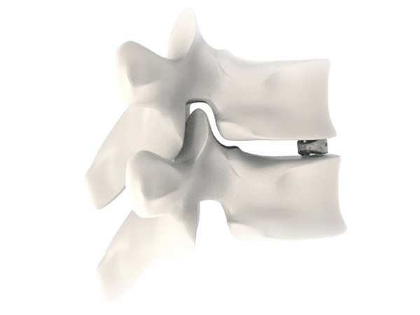 Tra-Ti Trabecular Tlif Cage