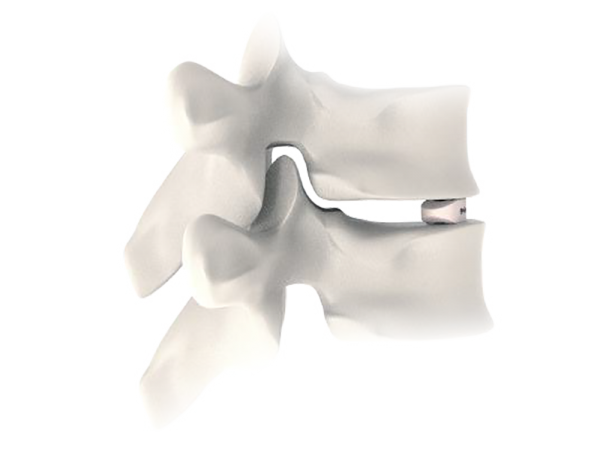 Twisty Tlif Peek Cage