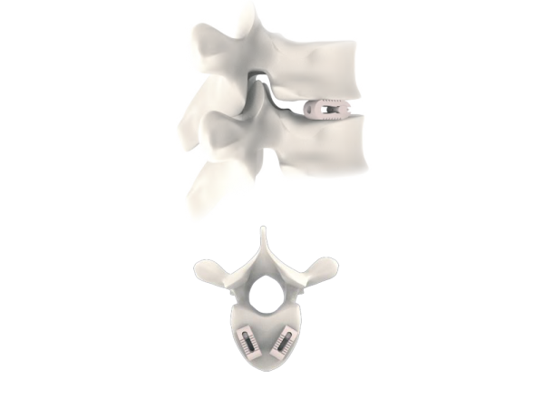 Alligator-Exp Plif Expandable Peek Cage