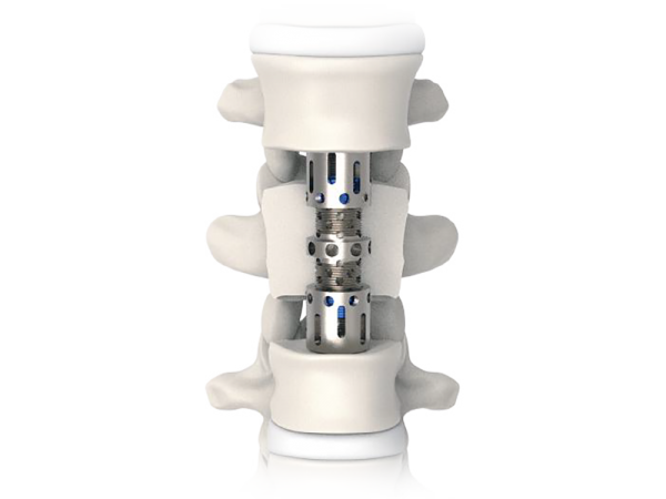 Vertelift-T Anterior Thoracolumbar Corpectomy Cage