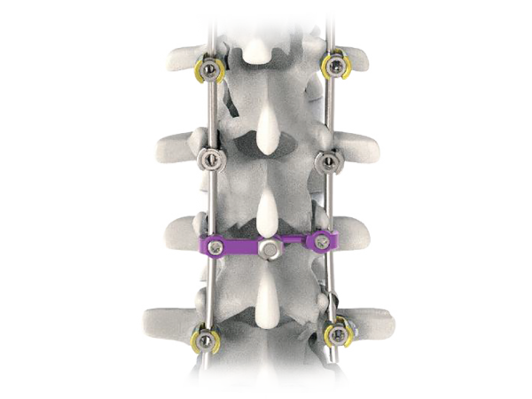 Pedifix Posterior Thoracolumbar Fixation System