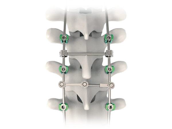 Rapidfix Dual Lead Thoracolumbar Screws