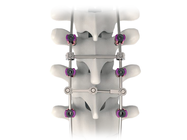 Quatro Quad Lead Thoracolumbar Screws