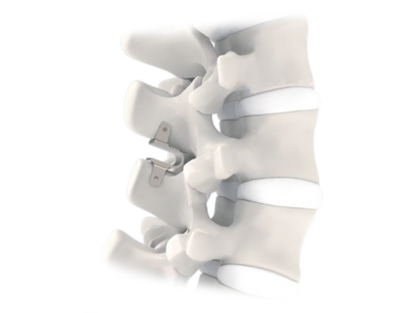 U-Device Interspinous Stabilisation Device