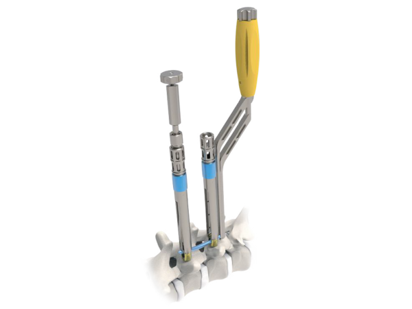 ARES Posterior Thoracolumbar MIS Screw System