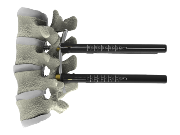 ARES Posterior Thoracolumbar MIS Screw System