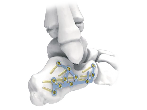 Calcaneal Locking Plate