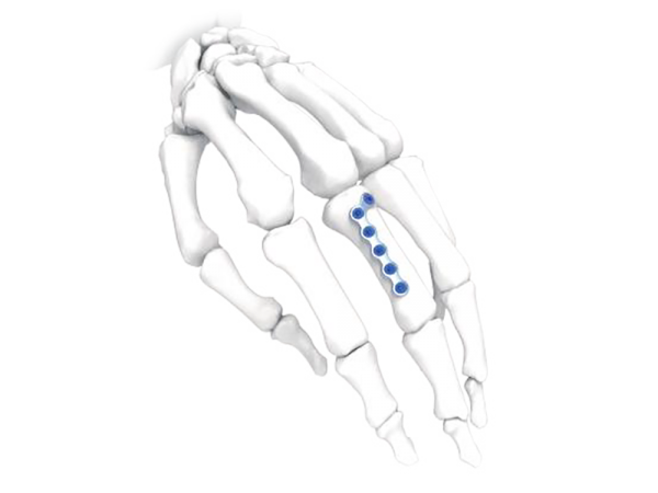 L Oblique Right Hand&Foot Plate