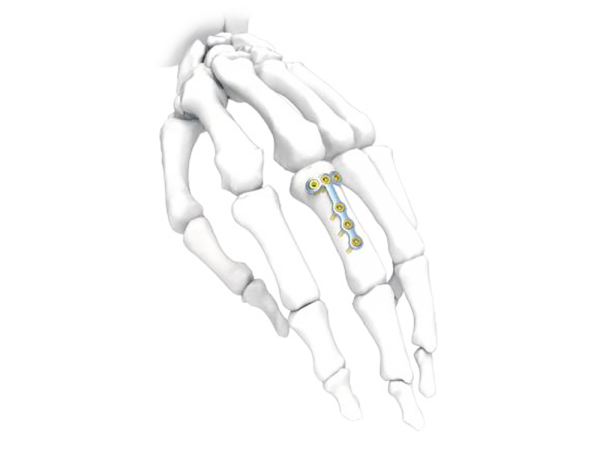 Mini Broad Hand Plate