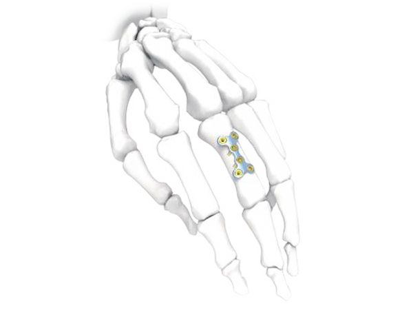Mini 2x2 Bridge Hand Plate