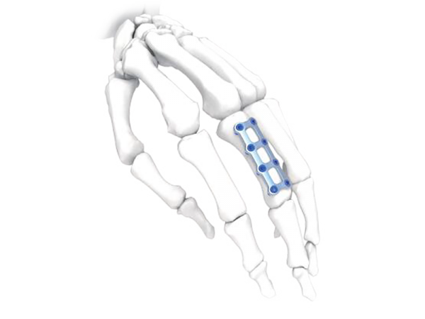 Mini 4x2 Bridge Hand Plate