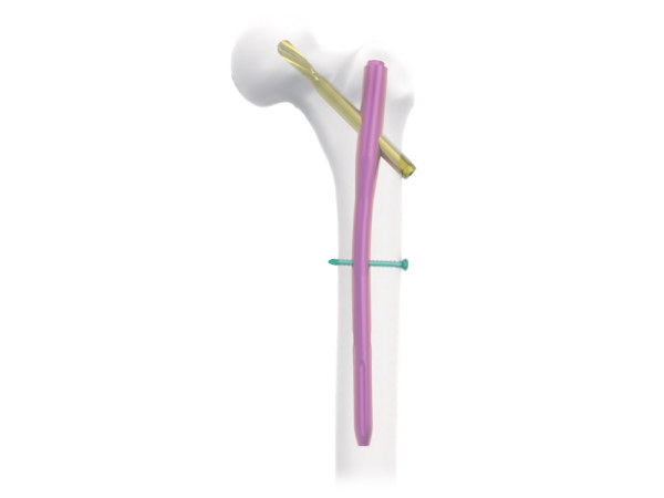 FTNA Femoral Trochanteric Nail