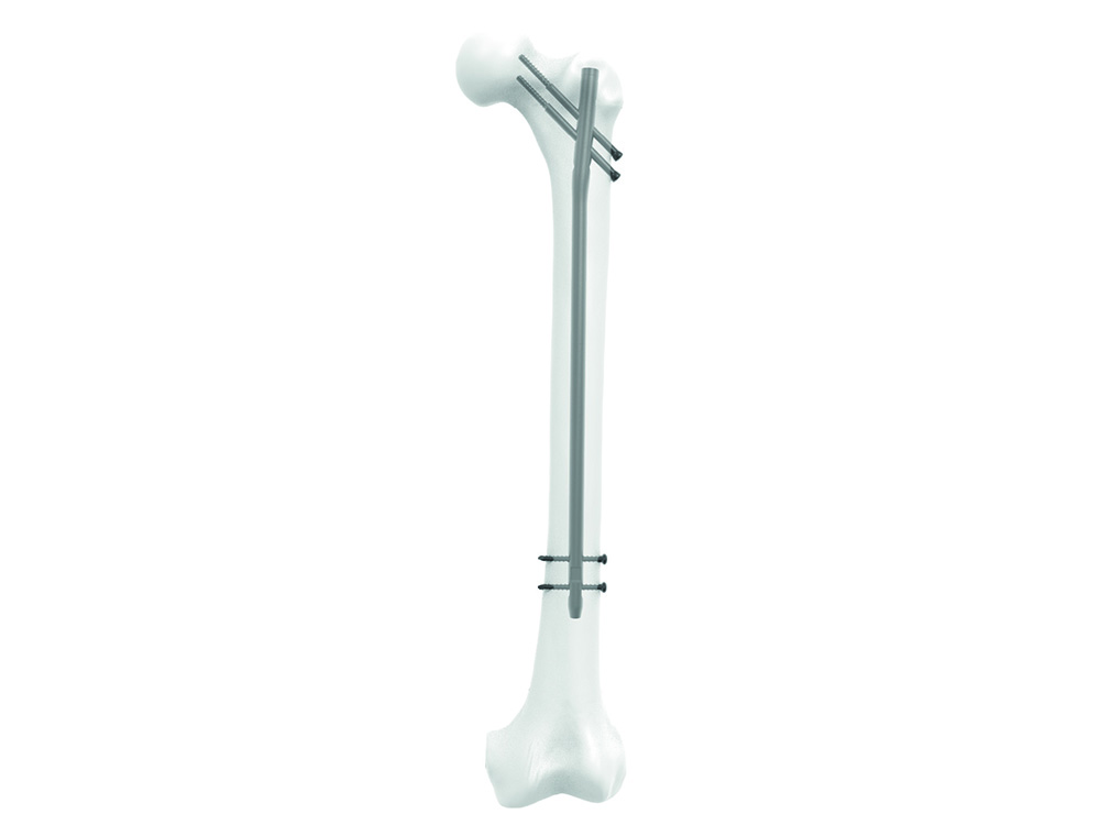 Trochanteric Entry Nailing for Pediatric Femoral Shaft Fractures |  Musculoskeletal Key