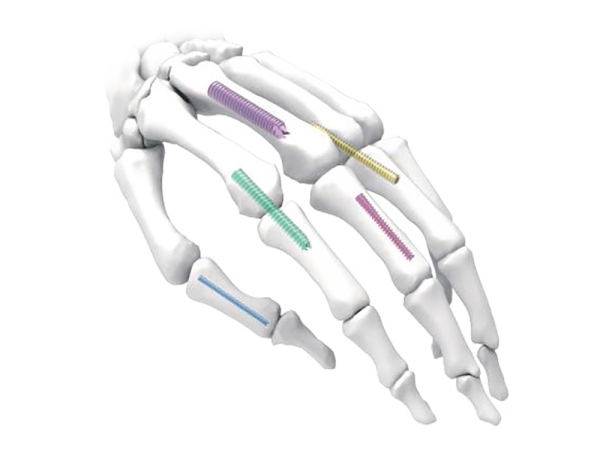 Headless Cannulated Compression Screw