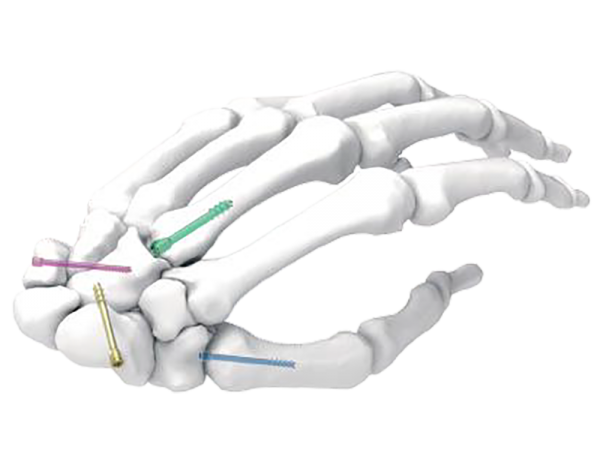 Herbert Cannulated Screw