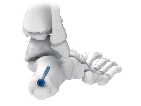 4.5 Cannulated Screw Instrument Set Screws