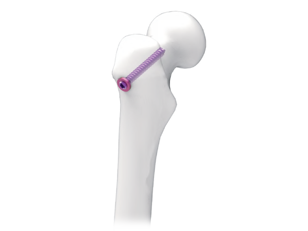 7.3 Cannulated Screw Instrument Set Screws