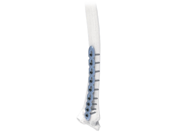 Pioneer Volar Radius Instrument Set Screws